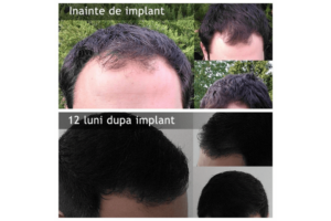 drfelixhairimplant (1)